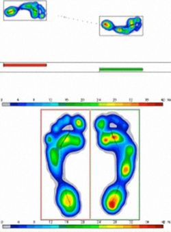 Fussdruckanalyse